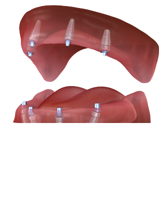 임플란트 시술순서 이미지1