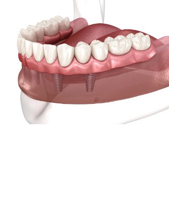 임플란트 시술순서 이미지3