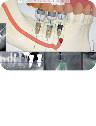 임플란트 시술순서 이미지2