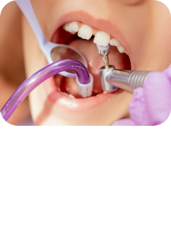 임플란트 시술순서 이미지4