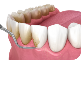 치아미백 시술순서 이미지1