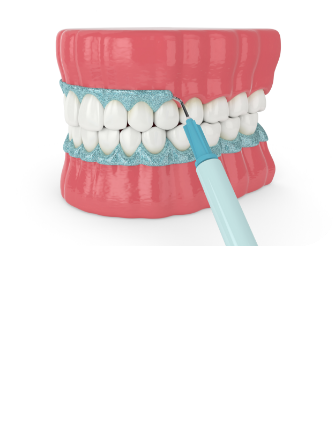 치아미백 시술순서 이미지2