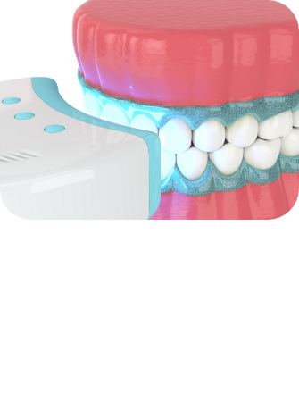 치아미백 시술순서 이미지4