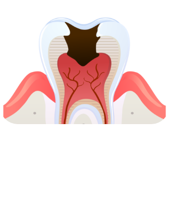 신경치료 시술순서 이미지1