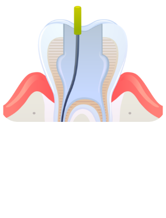 신경치료 시술순서 이미지2