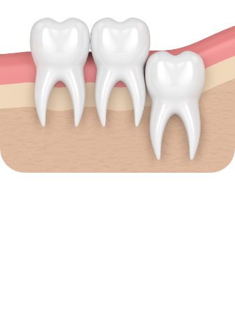 사랑니발치 순서 이미지2