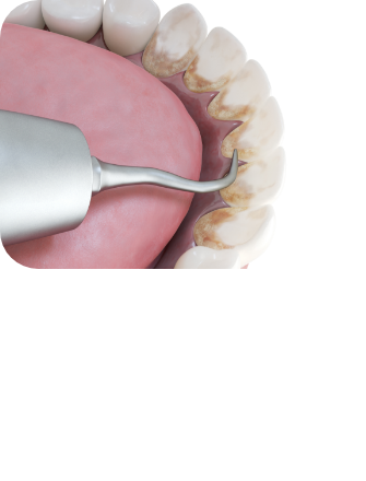 잇몸 치료방법 이미지1