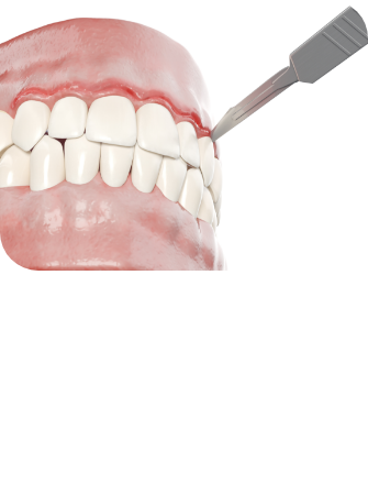 잇몸 치료방법 이미지2