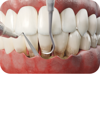 잇몸 치료방법 이미지3